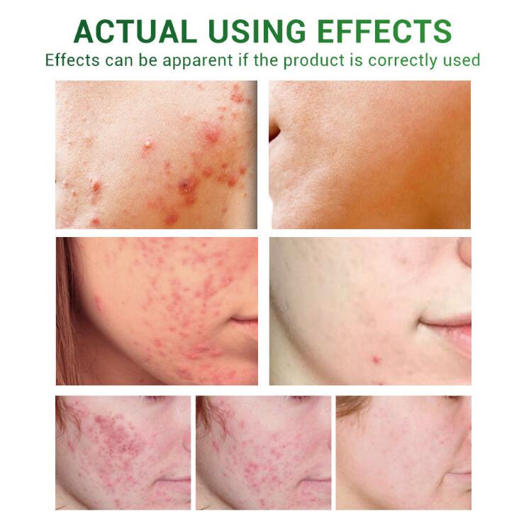 Essential Oils for Scar Repair and Skin Care